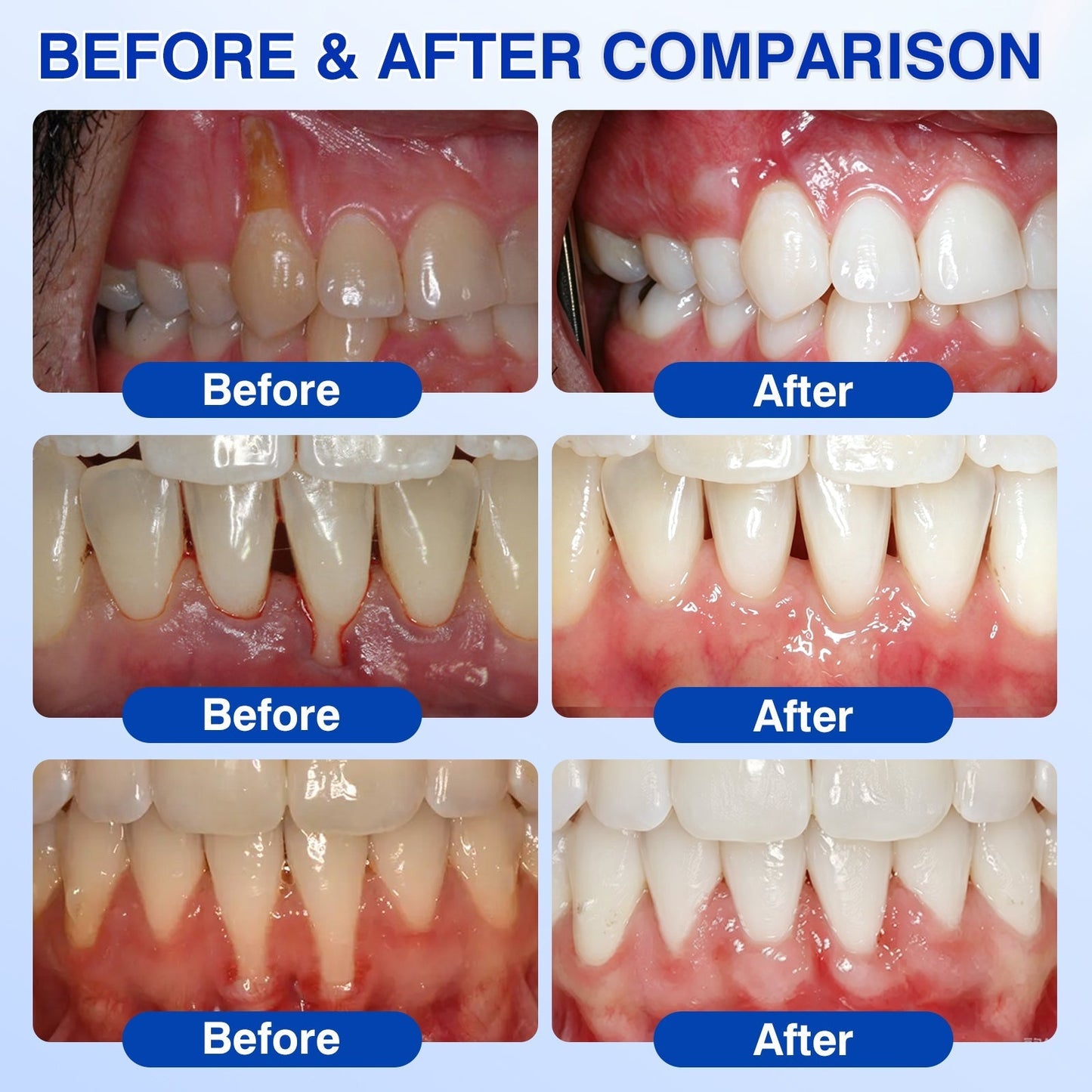 👨‍⚕️🦷🛡️SEAGRIL ® Gum health Periodontal Repair Gel